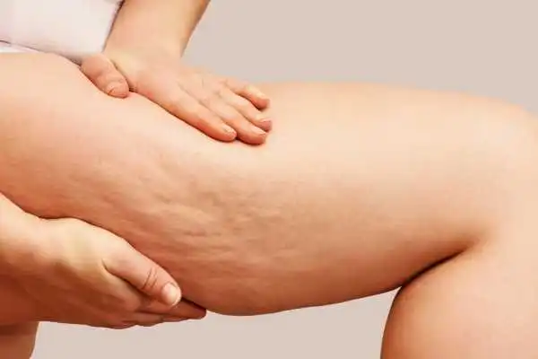 Image of woman showing leg with cellulite Little Bognor