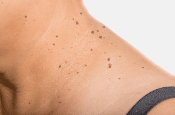 Are you looking for easy skin tag removal Little Bognor - then contact Spire today!
