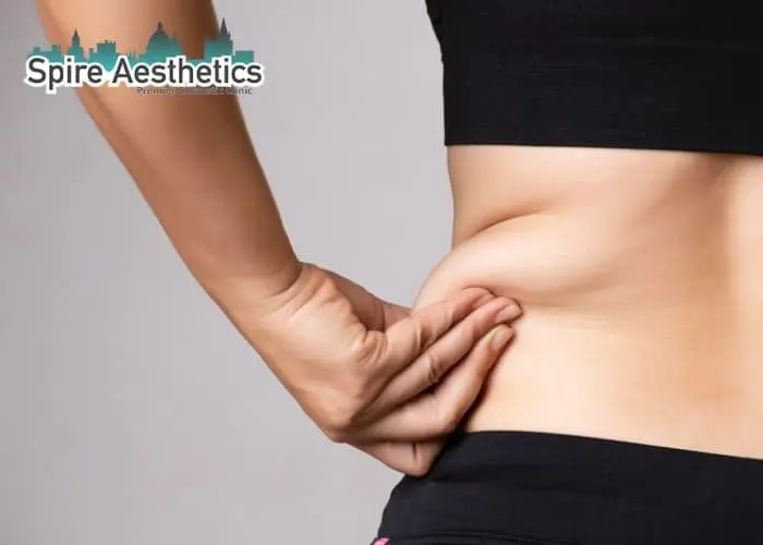Image of woman pinching fat on their hips Little Bognor. Fat Freezing treatment