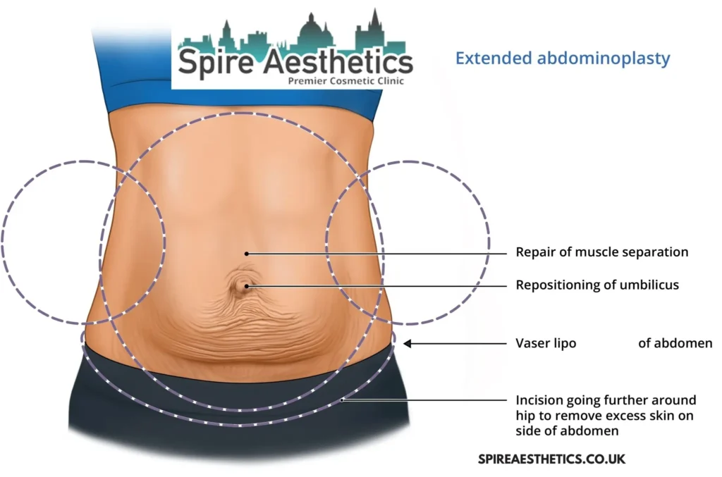 Understanding Loose Skin After Gastric Band Little Bognor Surgery and HIFU Treatment