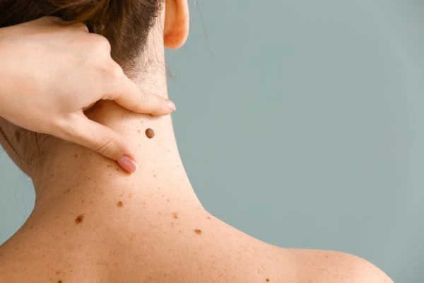 skin blemish removal Little Bognor treatment