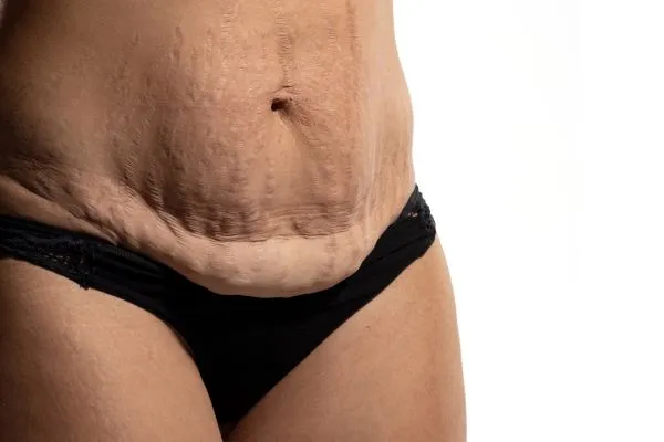 Image of womans stomach after weight loss injections Little Bognor showing saggy skin