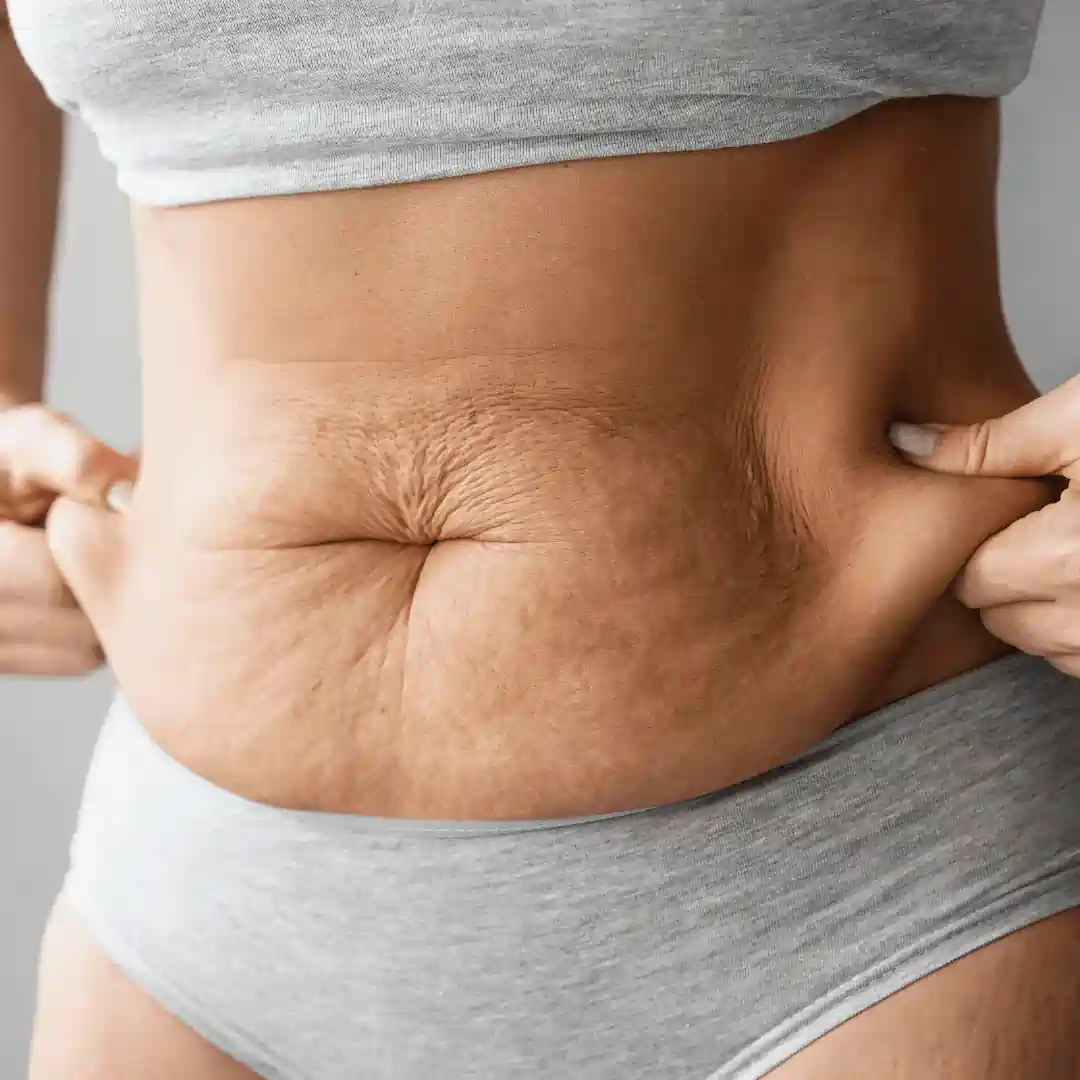 Is It Normal to Have Loose Skin After Pregnancy Little Bognor?
